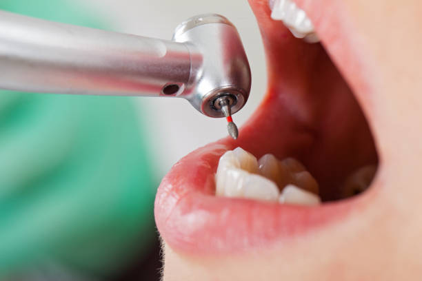 Best Emergency Root Canal Treatment in Wells Branch, TX